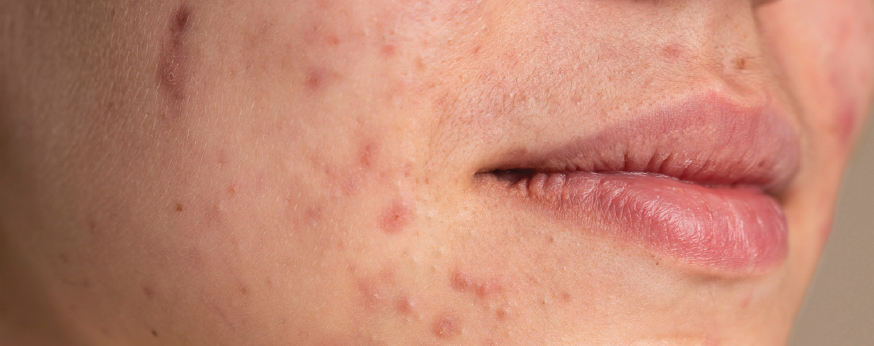 acne and acne scars