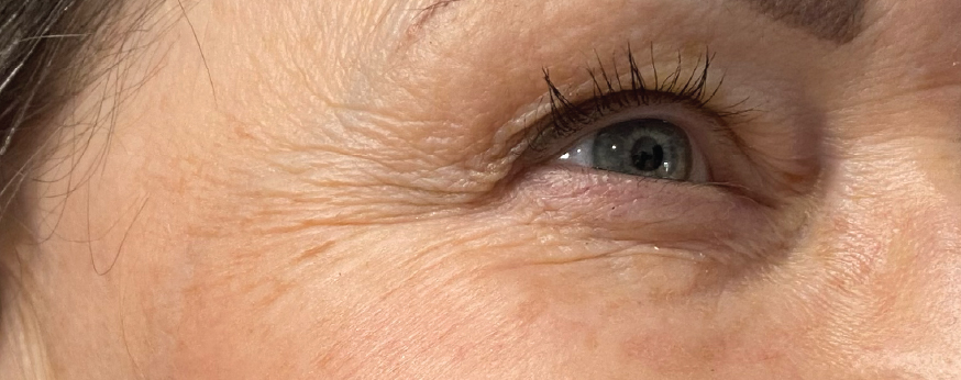 Fine lines and wrinkles