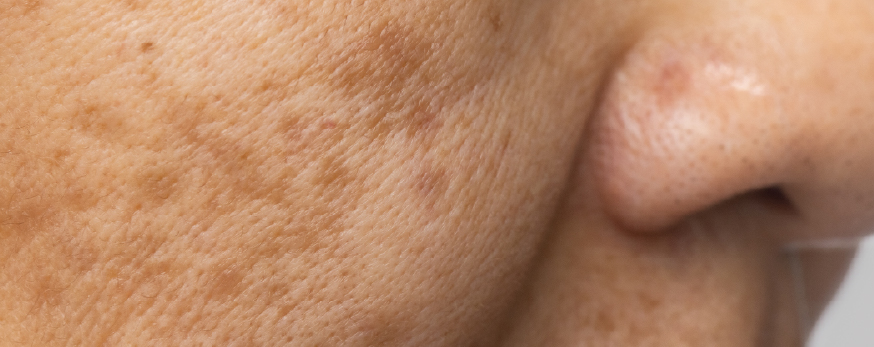 pigmentation hyper-pigmentation and melasma