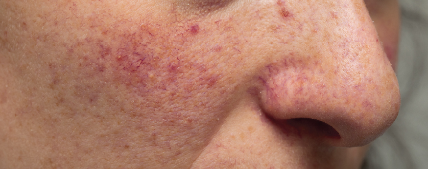 Rosacea and facial redness
